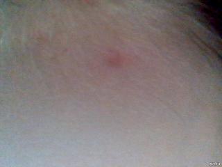 PIMPLE AHHHHHHH PIMPLE AHHHHHHH